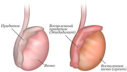 Опухло яичко у мужчины, болит &mdash; основные причины, способы лечения