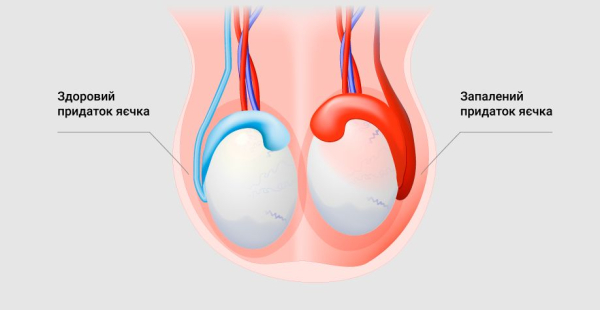 Опухло яичко у мужчины, болит &mdash; основные причины, способы лечения