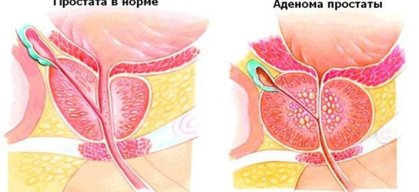 Опухло яичко у мужчины, болит &mdash; основные причины, способы лечения