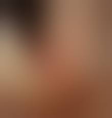 Папиллома голосовых связок: причины, симптомы и лечение