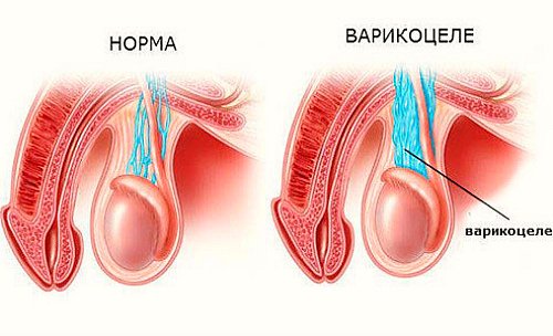 Остеохондроз и потенция: влияние заболевания на мужскую силу