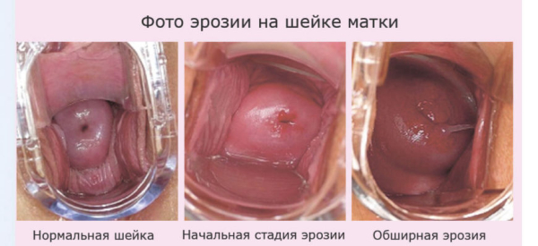 На УЗИ видна эрозия шейки матки или нет?