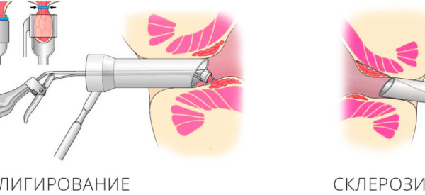 Тромбоз и воспаление геморроидального узла: лечение и удаление