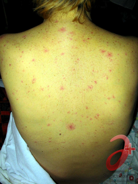 Как проявляется гепатит С и через сколько дней