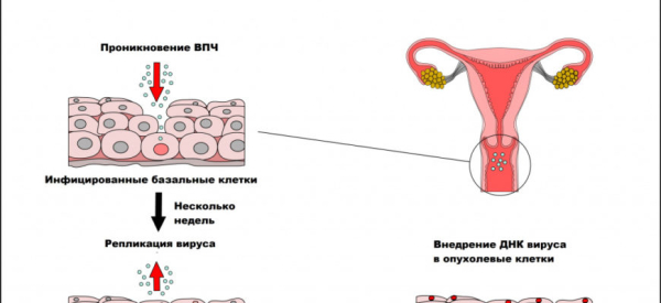 Вирус папилломы человека 35 типа: причины и лечение