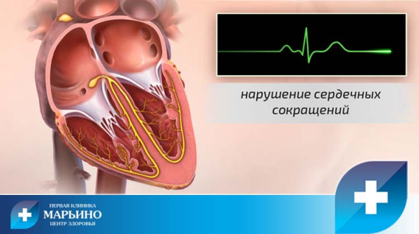 Перебои в сердце: причины, норма и патология, лечение