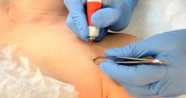 Уход за раной после операции по удалению папилломы