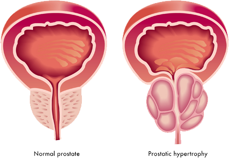 Может ли простатит вызывать запоры, как избавиться от симптома