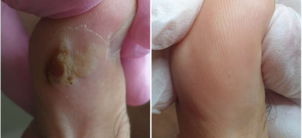 Как удалить бородавки между пальцами ног