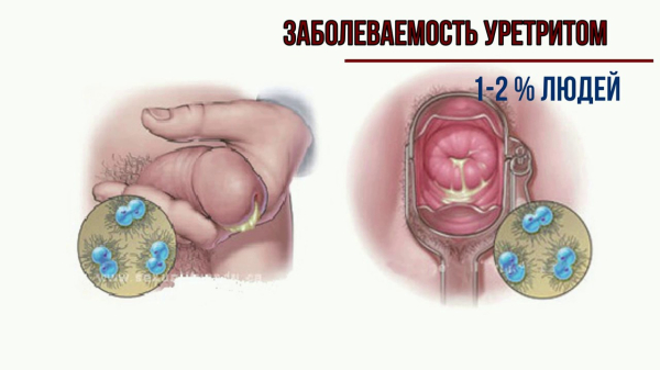 Уретрит у ребенка: чем лечить, симптомы
