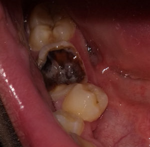 Удаление корня разрушенного или гнилого зуба: больно ли, процесс удаления