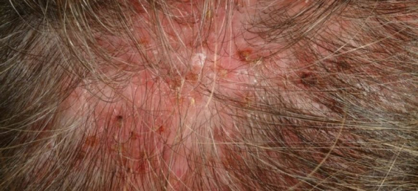 Лечение фолликулита народными средствами в домашних условиях