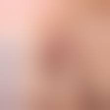 Как устранить отек после фурункула?