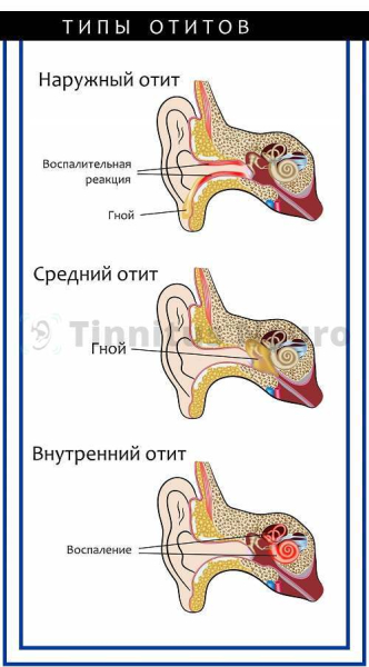 Гудит в ушах: причины гула и заложенности, их лечение