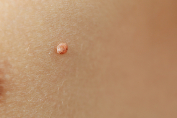 Лечение папиллом у детей народными средствами