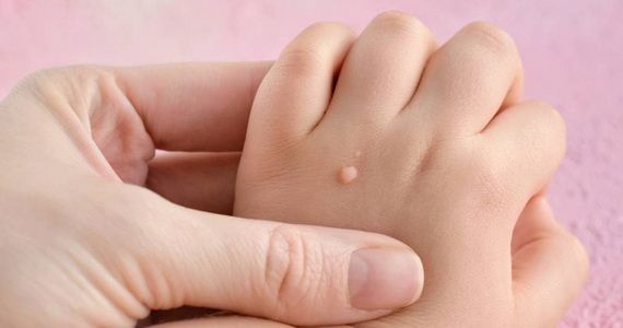 Последствия срыва бородавки: важная информация