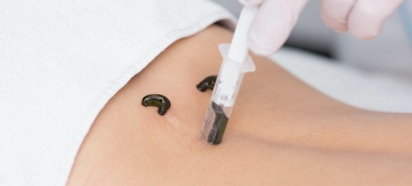 Лечение импотенции пиявками &mdash; что нужно знать мужчине