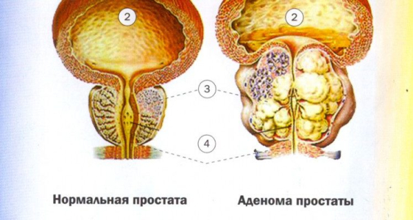 Лечение простатита и аденомы простаты голоданием у мужчин