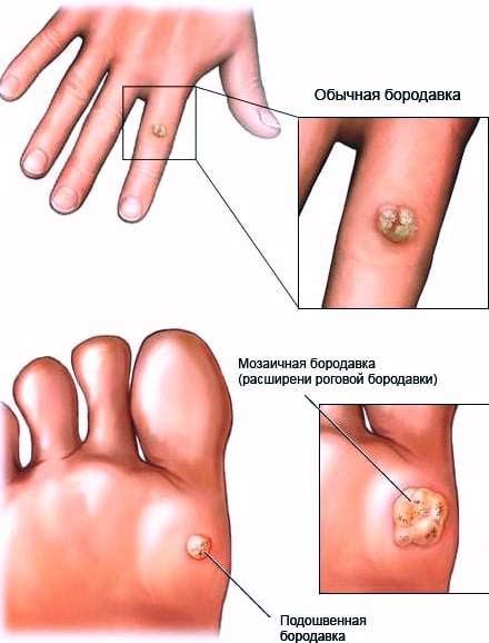 Бородавка между пальцев ног у ребенка