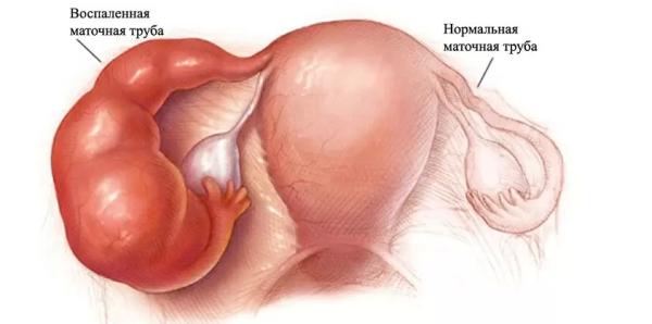 Гидросальпинкс лечение без операции