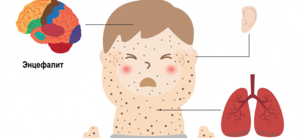 Особенности ветряночного энцефалита
