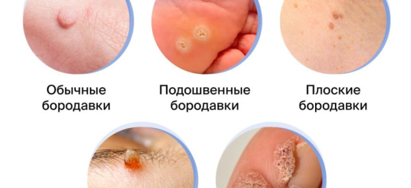 Бородавки на спине: причины появления и способы лечения