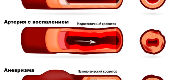 Узелковый периартериит: понятие, причины, течение, диагностика, лечение