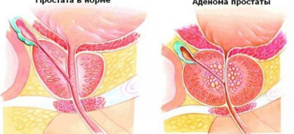 Может ли простатит вызывать запоры, как избавиться от симптома
