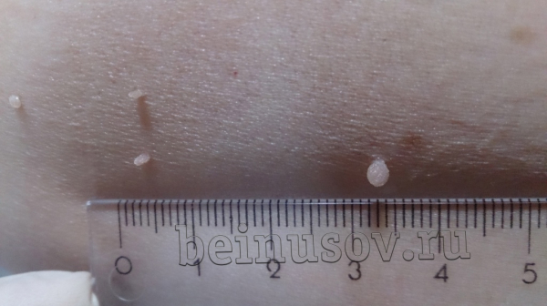 Папиллома покраснела, что делать?