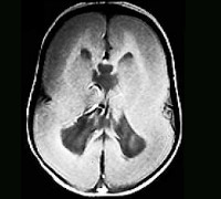 Лиссэнцефалия &mdash; есть ли шанс, если у ребенка &laquo;гладкий&raquo; мозг