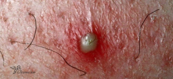 Стафилококковый фолликулит: что это такое и как его лечить