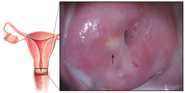 Лечение кисты на шейке матки
