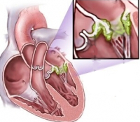 Ревмокардит: причины, симптомы, диета и лечение