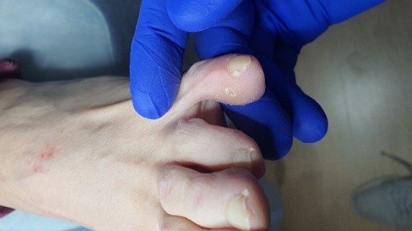 Как удалить бородавки между пальцами ног