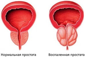 Может ли простатит вызывать запоры, как избавиться от симптома