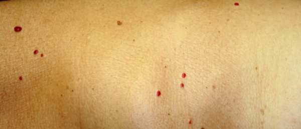 Что такое венозная ангиома головного мозга: причины, лечение, прогноз