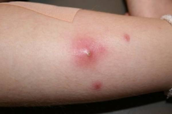 Не выходит стержень фурункула &mdash; что делать?