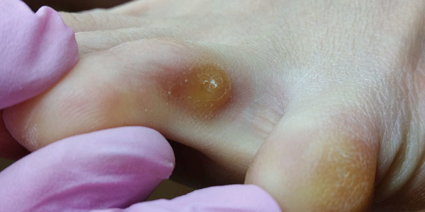 Бородавка между пальцев ног у ребенка