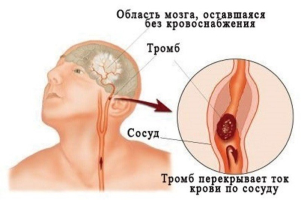Дисциркуляторная энцефалопатия (ДЭП): развитие и диагноз, симптомы и стадии, терапия