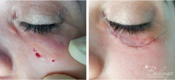 Как удалить папиллому на нижнем веке?