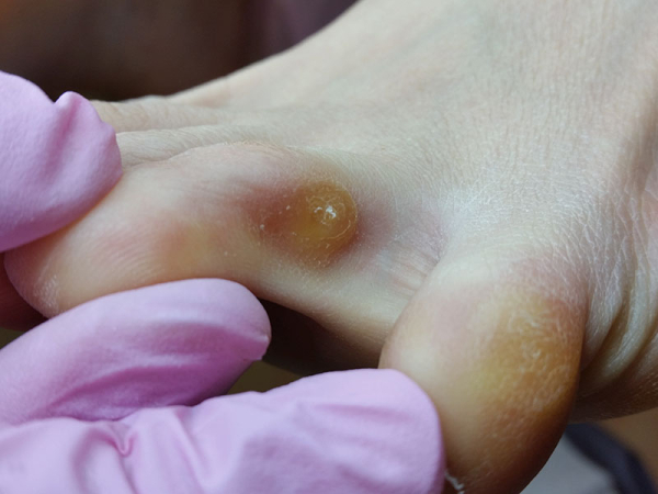 Бородавка между пальцев ног у ребенка