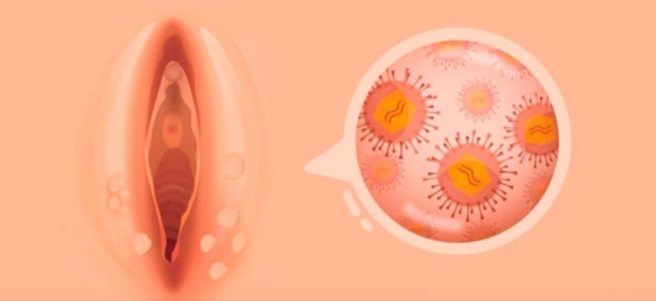 Отличие папилломы от кондиломы