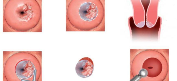 Конизация шейки матки: процедура, показания и последствия