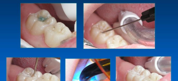 Герметизация фиссур зубов у детей и взрослых: что это, за и против