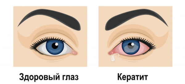 Акантамебный кератит: лечение, симптомы, диагностика