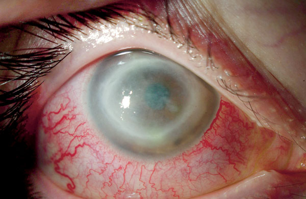 Акантамебный кератит: лечение, симптомы, диагностика