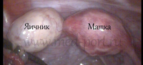 Причины увеличения яичника у женщин