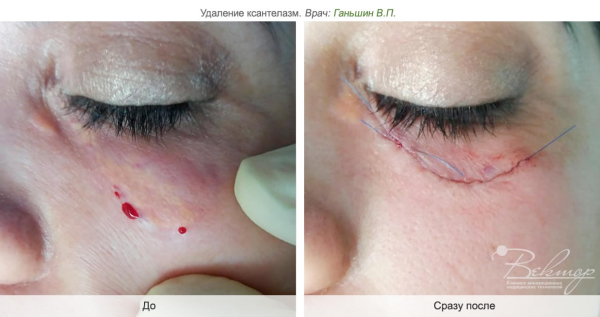 Как удалить папиллому на нижнем веке?