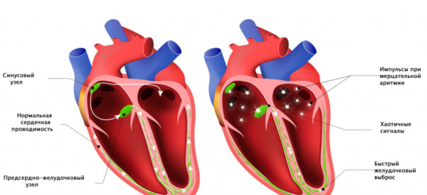 Перебои в сердце: причины, норма и патология, лечение