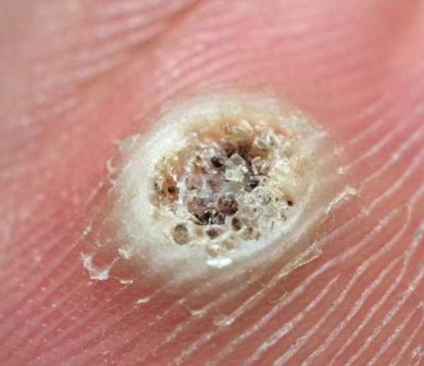 Трихлоруксусная кислота для прижигания бородавок